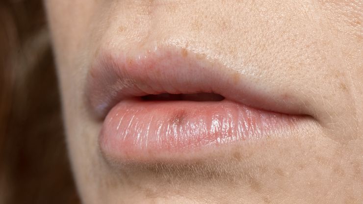 Bibir Kering? Temukan Penyebabnya dan Cara Mudah Mengatasinya