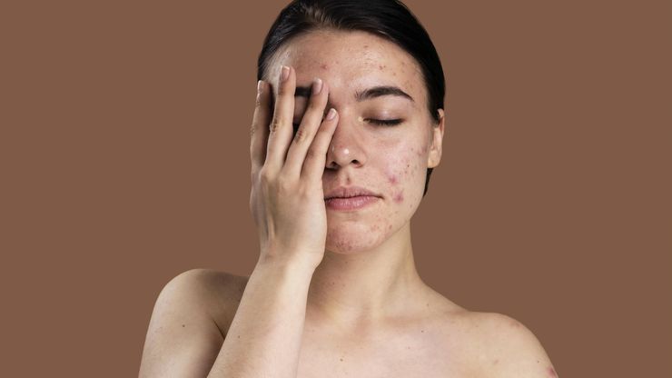 Waspada Efek Samping Retinol pada Wajah!